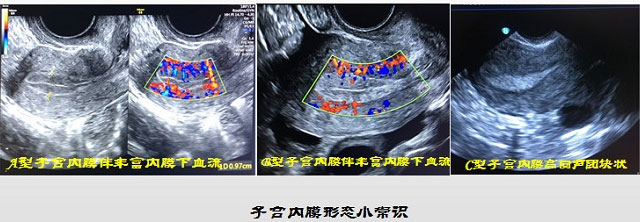 不一样形状子宫内膜实图