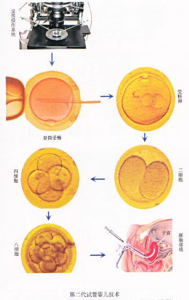 第二代试管婴儿技术