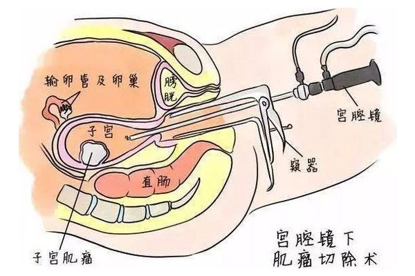宫腔镜手术平面图