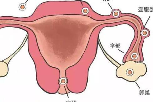 宫外孕是什么